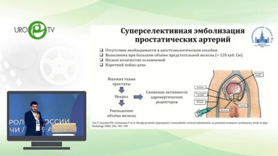 Шапаров Б.М. -  Суперселективная эмболизация простатических артерий в лечении ДГПЖ