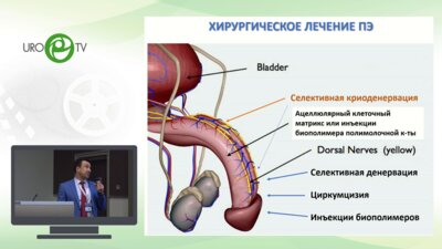Миркин Я.Б. - Селективная криоденервация полового члена