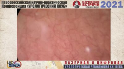 Волков С.Н. -Операция Лазерная en bloc резекция опухоли мочевого пузыря