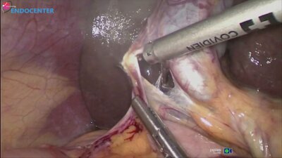 Laparoscopic cholecystectomy _ Лапароскопическая холецистэктомия