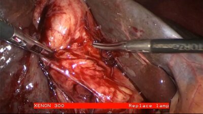 Laparoscopic Choledocholithotomy