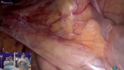 Laparoscopic correction cystovaginal fistula LIVE complicated case