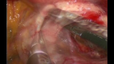 Laparoscopic correction of radiation complications after cervical cancer treatment