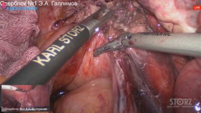 Laparoscopic deep infiltrative endometriosis LIVE (1)