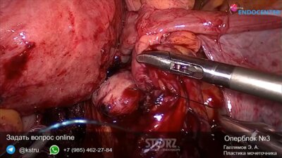 Laparoscopic deep infiltrative endometriosis with colonic resection and ureter