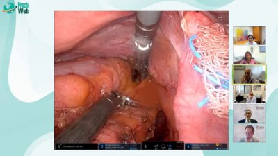 Brain Bednarski - Mesorectal Division. Rectal transection. Anasomosis