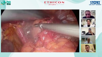 Дивертикулярная болезнь толстой кишки. Выступление Башанкаева Бадмы Николаевича