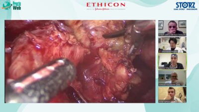 Дивертикулярная болезнь толстой кишки. Выступление Маркарьяна Даниила Рафаэлевича