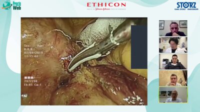 Дивертикулярная болезнь толстой кишки. Выступление Москалева Алексея Игоревича