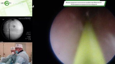 Мартов А.Г. - Ретроградная интраренальная хирургия