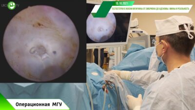 Сорокин Н.И. - Энуклеация тулиевым лазером