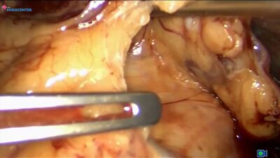 Laparoscopic Distal Pancreatectomy LIVE _ Лапароскопическая дистальная резекция 