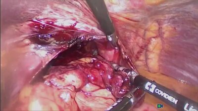 Laparoscopic fundoplication LIVE_ Лапароскопическая фундопликация_Живая хирургия