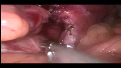 Laparoscopic fundoplication,cholecystectomy