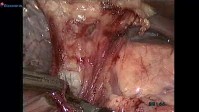 Laparoscopic Gastrectomy D2 hand sewn EEA