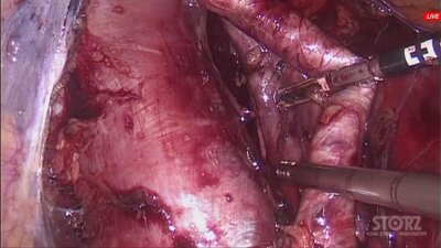 Операция 2. Галлямов Э.Д. - Лапароскопическая крурорафия, фундопликация