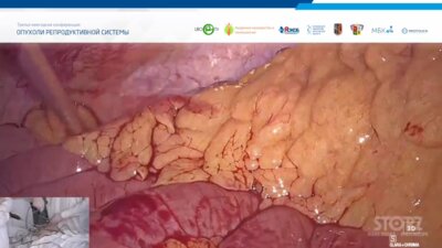 Котов С.В. - Трансляция из операционной ГБУЗ ЯО Областная клиническая онкологическая больница. Радикальная лапароскопическая простатэктомия