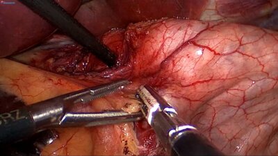 Laparoscopic fundoplication LIVE