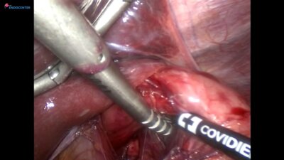 Laparoscopic Heller cardiomyotomy LIVE