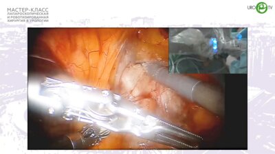 Грицкевич А.А. - Робот-ассистированная резекция почки с кистой
