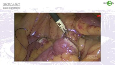 Кочкин А.Д. - Лапароскопическая кишечная пластика мочеточника