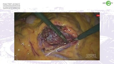 Дмитренко Г.Д. - Лапароскопическая пластика ЛМС