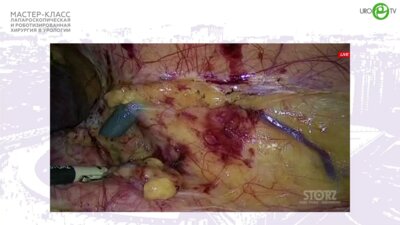 Шевченко А.Н. - Лапароскопическая резекция почки с опухолевым узлом. RENAL 8