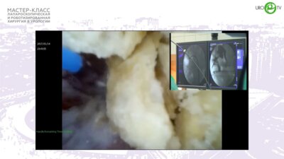 Мартов А.Г. - Эндоскопическая хирургия при МКБ