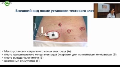 Коршунова Е.С. - Сакральная нейромодуляция. Опыт нейроуролога