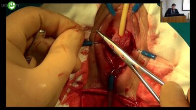 Еркович А.А. - Дистальная уретропластика ротированным влагалищным лоскутом