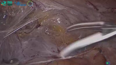 Агапов М.А. - Оперативное лечение выпадения прямой кишки