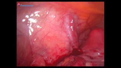 Laparoscopic myomectomy _ Консервативная миомэктомия (1)