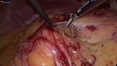 Laparoscopic left partial nephrectomy, zero ischemia