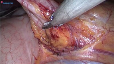 Лапароскопическая пластика ЛМС