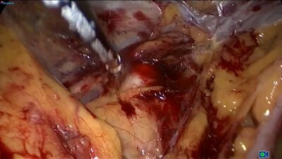 Laparoscopic left radical nephrectomy LIVE