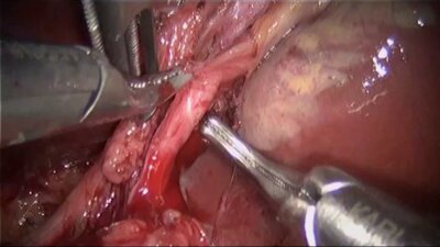 Laparoscopic living donor hepatic resection