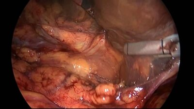 Биктимиров Р. Б. - Лапароскопическая билатеральная нефрэктомия