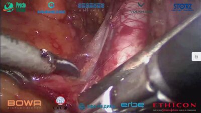 Сергеев В. П. - Лапароскопическая простатэктомия