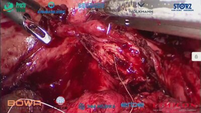 Галлямов Э.А. - Лапароскопический ретроцервикальный эндометриоз