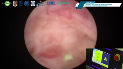 Цариченко Д.Г. - Трансуретральная лазерная энуклеация аденомы простаты