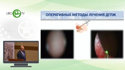 Камалов Д.М. - Трансперинеальная перкутанная лазерная абляция гиперплазии предстательной железы