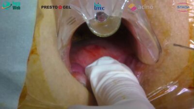 Маркарьян Д.Р. - Оперативное лечение сложного свища прямой кишки