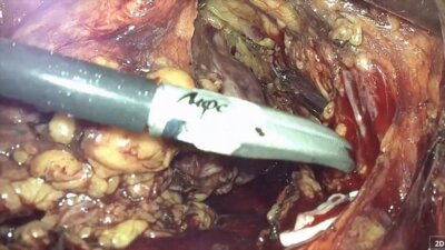 Laparoscopic nephrectomy & anterior exenteration LIVE  Нефрэктомия, передняя эк