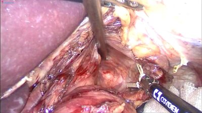Laparoscopic oesophaeal diverticulus removal