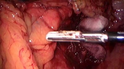 Laparoscopic pelvic abscess, sigmoid resection
