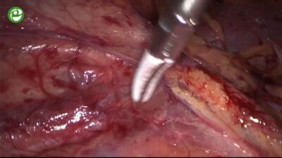 Laparoscopic partial nefrectomy 2016 _ Лекция_ Принципы диссекции тканей
