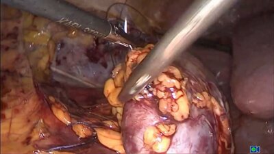 Laparoscopic partial nephrectomy LIVE - Лапароскопическая резекция правой почки