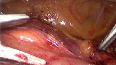 Laparoscopic partial nephrectomy, giant angiomyolipom LIVE _ Резекция почки анги