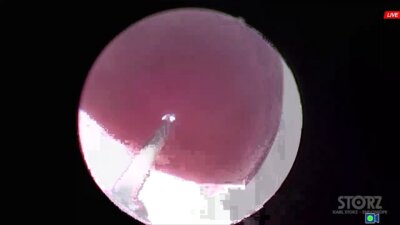 Сорокин Н.И. - Трансуретральная энуклеация простаты karl storz CALCULASE III