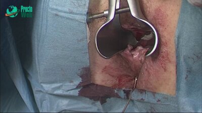 Маркарьян Д.Р. - Оперативное лечение сложного транссфинктерного свища прямой кишки